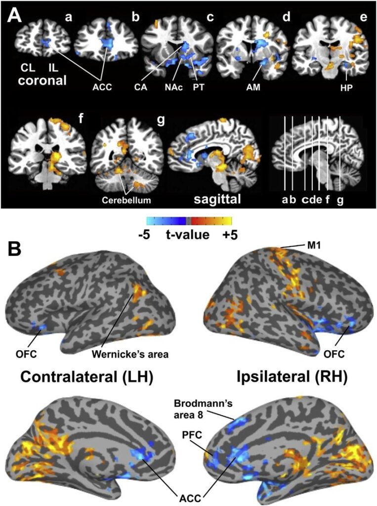 Intraoperative-fMRI-during-thalamic-HFS-A-Thalamic-HFS-showing-both-significant